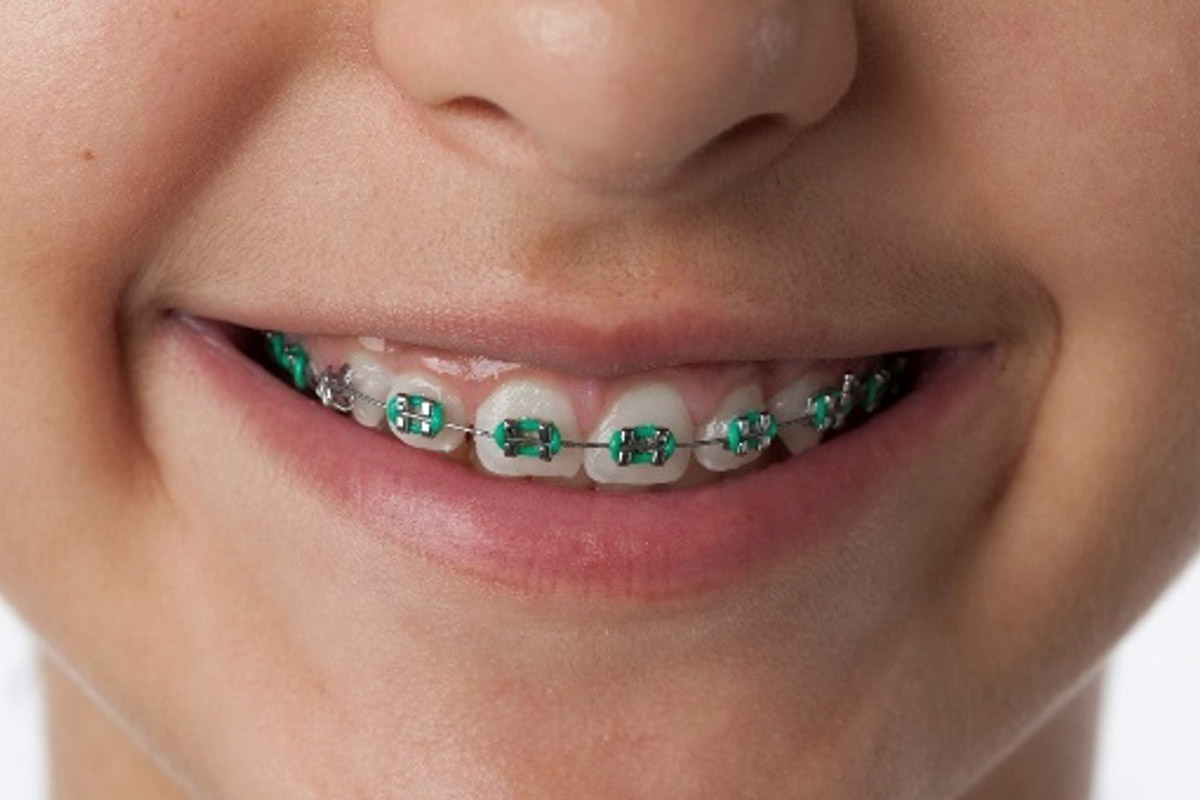 Invisalign Malaysia The Ultimate Guide (2023) Dental Clinic