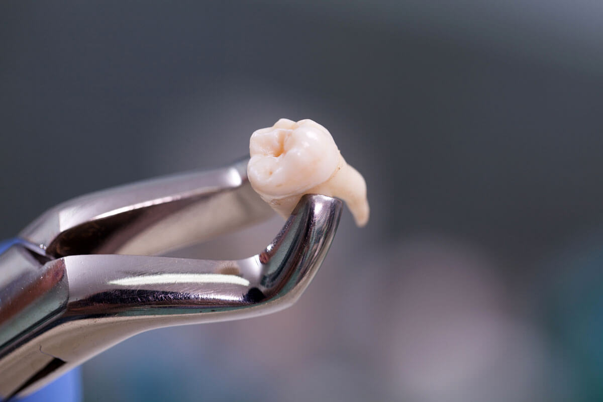 “Wisdom tooth extraction procedure by oral surgeon in Subang Jaya”